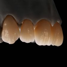 Vollkeramik (Zirkon)